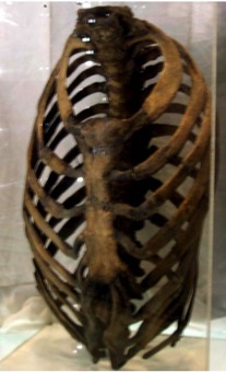 How the Cultural Becomes Biological: Evidence for Corseting in the Skeletal  Record
